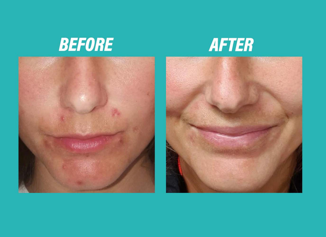 ACN PROBIOTIC REPAIR Gezichtscrème 50 ml